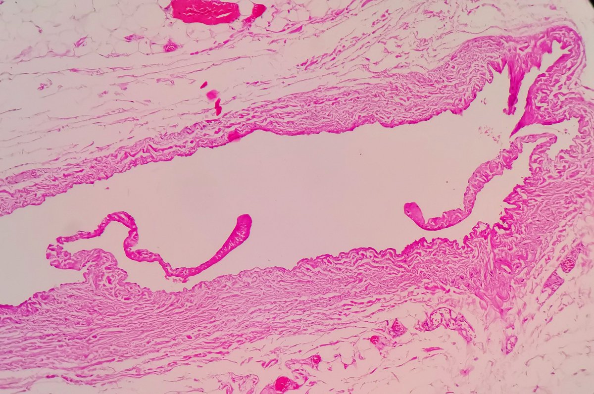 padmapathology1's tweet photo. #SmallLittleThings in #pathology
Valves in the veins
#cardiacpath #bstpath #PathTwitter #pathresidents https://t.co/HLobkPGB3R