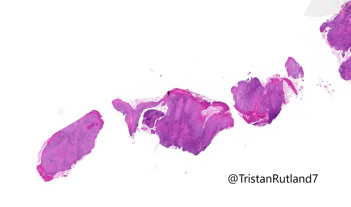 kiko4docs's tweet image. Young adult with lip lesion. Special stains negative. Diagnosis?
Answer &amp;amp; More info: kikoxp.com/posts/9905 
More posts from Dr. Rutland @TristanRutland7 kikoxp.com/tristan_rutlan…
#pathology #pathTwitter #medTwitter #oralpath #ENTpath