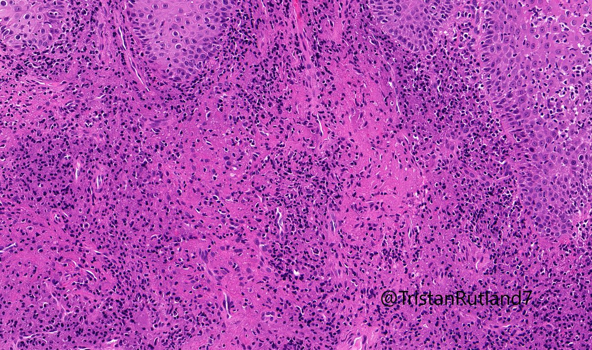 kiko4docs's tweet image. Young adult with lip lesion. Special stains negative. Diagnosis?
Answer &amp;amp; More info: kikoxp.com/posts/9905 
More posts from Dr. Rutland @TristanRutland7 kikoxp.com/tristan_rutlan…
#pathology #pathTwitter #medTwitter #oralpath #ENTpath