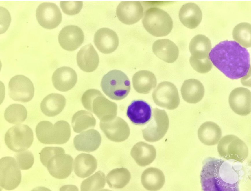 Abdallah81MD's tweet photo. AML showing  3 Howell-Jolly bodies 🙂 in a polychromatophil red cell. (nuclear remnants) 
#MedTwitter #MedEd #hemepath @ASH_hematology #USMIRC https://t.co/V7XfbKS1YY