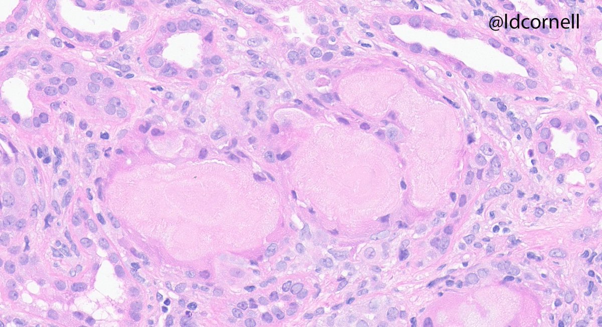 ldcornell's tweet photo. Congophilic cast nephropathy (lambda+) in a pt with AKI. “Spicules” on periphery of casts. No amyloid in the glomeruli, vessels, or interstitium. This is usually not assoc with systemic amyloidosis (in our experience). #renalpath @Renalpathsoc @MayoClinicPath @MayoClinicNeph https://t.co/LJKlw11iTf
