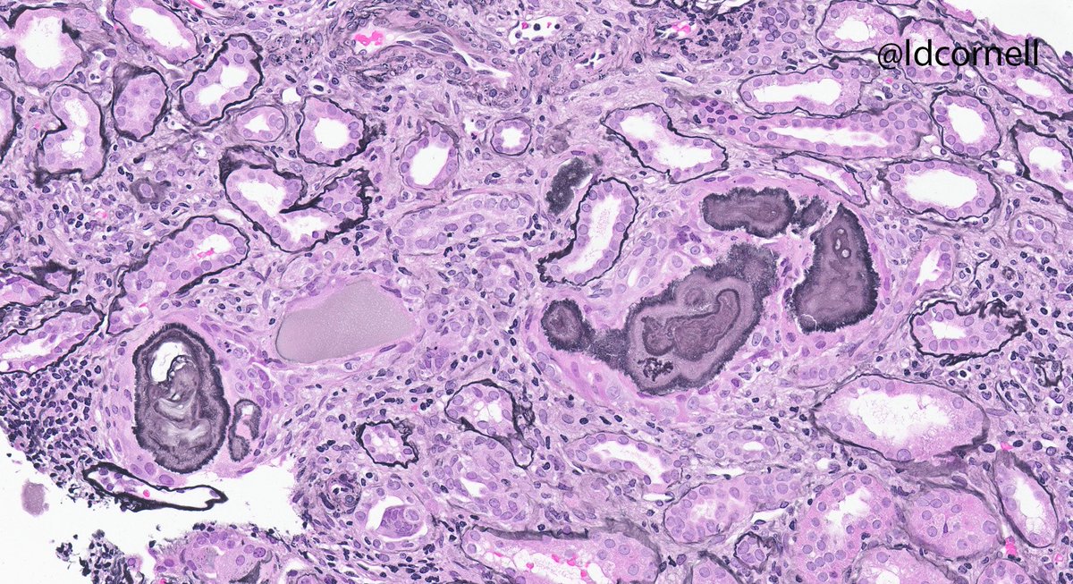 ldcornell's tweet photo. Congophilic cast nephropathy (lambda+) in a pt with AKI. “Spicules” on periphery of casts. No amyloid in the glomeruli, vessels, or interstitium. This is usually not assoc with systemic amyloidosis (in our experience). #renalpath @Renalpathsoc @MayoClinicPath @MayoClinicNeph https://t.co/LJKlw11iTf