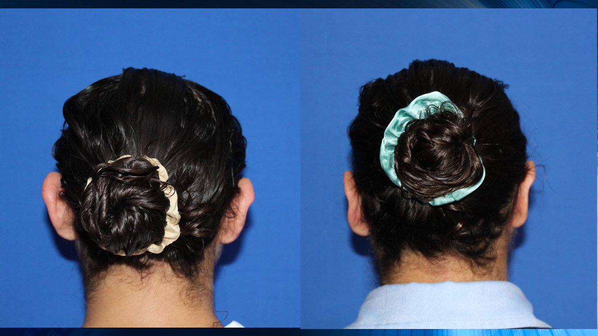 jesusgodinez's tweet photo. La Otoplastia es un procedimiento en el cual llevamos el pabellon auricular a una posicion mas posterior, esto lo realizamos con anestesia local, es decir termina el procedimiento y el paciente se retira a casa. #doctorjesusgodinez, #cirugiafacialgodinez, #otoplastia, https://t.co/wNnxV7YPv1