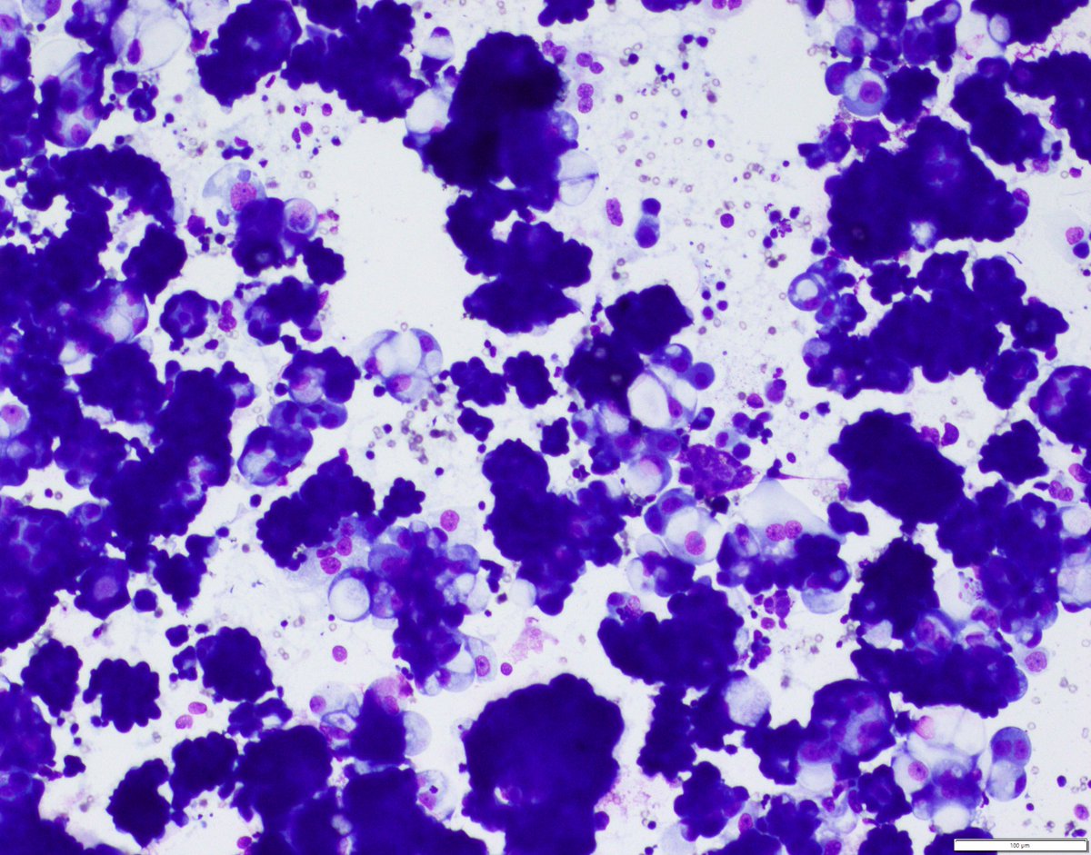 UpstateCytology's tweet photo. Ascitic fluid in a 67 yo F with a pelvic mass. Differentials? Stains? #PathTwitter #pathX #cytology #cytopathology https://t.co/VF9S7awYQI