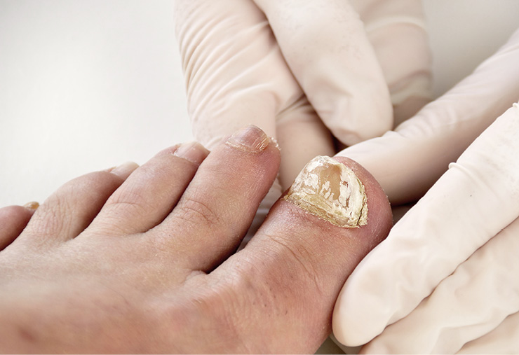 elzorrotacneno's tweet photo. La Onicomicosis (Hongos en las uñas).
Todo lo que posteo, referente a la salud, lo hago desde la perspectiva de la Medicina Tradicional China, y el naturismo. 
De un tiempo a esta parte se han incrementado las afecciones en las uñas, pero una mirada mas profunda nos señala otro crecimiento social preocupante: La violencia, producto del enfado.
¿Y qué tendría que ver las uñas con la violencia?
Así como la emoción que empoza a los riñones es el miedo, la cólera, rabia y la ira afectan al Hígado y la Vesícula.
El Hígado se afecta mas por rabia y resentimiento que por alcohol y tocino.
Los tejidos que gobierna el Hígado son los tendones, las uñas y se expresa en los ojos.
Entonces, cuando una persona tiene mucha ira , cólera y rabia crónica, comienza a afectar su Hígado, luego aparecen calambres y finalmente, los hongos, al no encontrar buenas defensas en las uñas, comienzan a afectar las uñas: El hongo en la uña del dedo gordo del pie, es un claro indicativo.
No busque cremas y pastillas anti hongos: Trátense el Hígado y se les va los hongos.
Y lo principal: NO RENIEGUE: