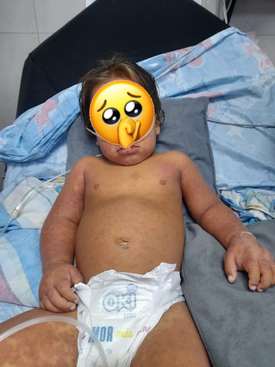 SinbotrasaludC's tweet photo. Gobernador Rafael Lacava.
Se require ayuda al niño Herrera de dos años.Hospitalizado en la CHET,área de hidratación pediátria.Necesita dos ampollas de inmunoglobulina,costo de ampolla un valor $400 sus padres están desesperados no tienen dinero, el hospital ayudo con 17g. 🙏🏻 https://t.co/rAGYLNRSpA