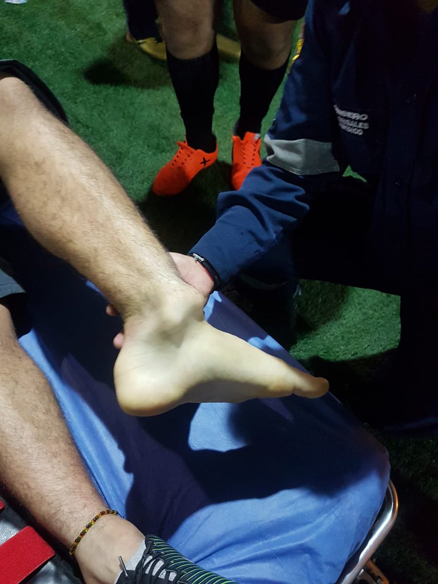 Asi quedo la pierna de Clarc despues del violento cabezazo con malicia que le metio Alfio Oviedo...
El futbolista de Cerro Porteño jugo gratis el resto del partido sin duda..