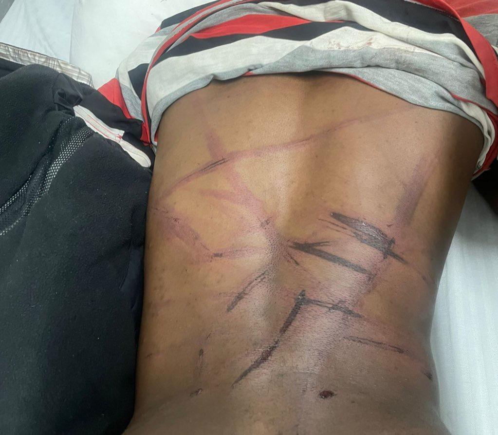 ptsbere's tweet photo. The distressing incident involving @Cde_Wombe illustrates a troubling pattern. The question arises: what justified such a violent act against him? His affiliation with the opposition seems to have made him a target. This ongoing situation unfolds as individuals are targeted one by one, leaving us to wonder when these injustices will cease. The cycle of violence and intimidation continues, and those responsible for such actions must be held accountable.

#EndPoliticalViolence #JusticeForAll #StopIntimidation #AccountabilityMatters