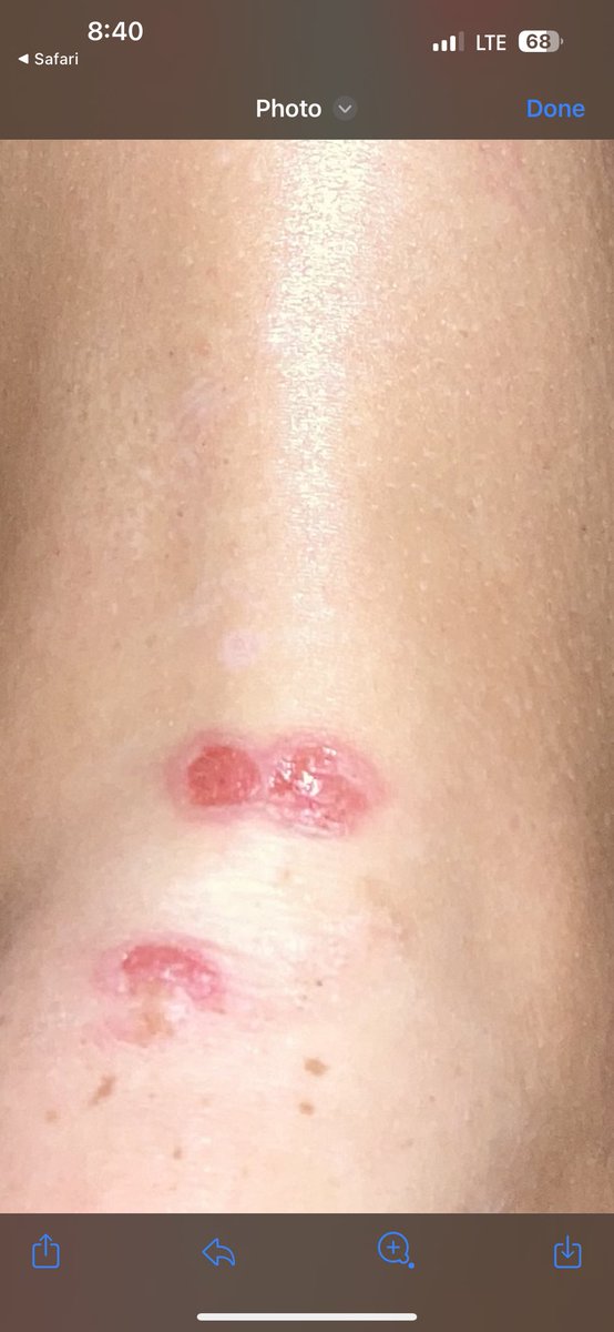 Any docs know what this may be? 3 day rash only 1 leg. Spreading white spots that ooze in 15 year old. And knee pain. @PedEMMorsels @HandtevyMD @EmilyRoseMD1