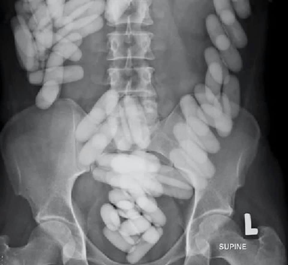 patient with pain and fever. 

Diagnosis?

<a href="/drkeithsiau/">Keith Siau</a> #MedEd #MedTwitter