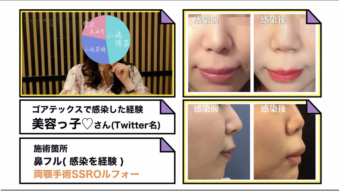 875H's tweet photo. 整形カイワイさんとYouTube動画作成
いただきました✨　

簡潔に私の鼻感染、失敗の壮絶泥沼体験🐽😱の経緯、クリニックをお話しさせて頂いております

お鼻の手術を考えている方は参考によかったらご覧くださいませ😉❤︎ 
https://t.co/L7cx0jr2Ux https://t.co/3MqtJJE7d7
