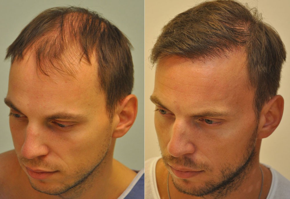 drSikosGeza's tweet photo. #Sikosdr. #FUE #hajbeültetés kiváló eredménye 10 hónappal műtét után 3012 graft,6598 hajszál  #Sikosdr. excellent result of #FUE #hairtransplant 10 months after surgery 3012 grafts 6598 hairs #Sikosdr #FUE #Haartransplantation #SikosClinic, #drSikosBudapest #hairtransplantHungary https://t.co/mVhm7GTjWg