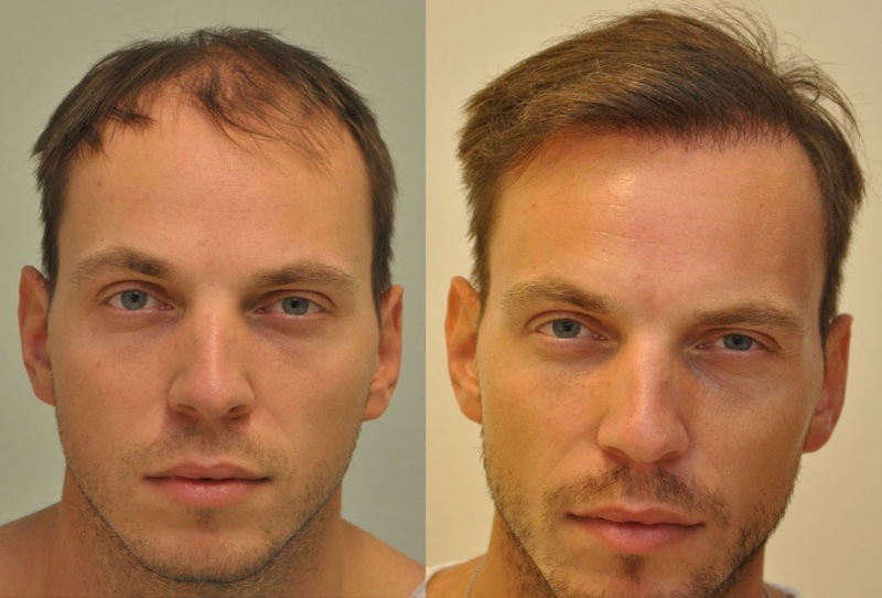 drSikosGeza's tweet photo. #Sikosdr. #FUE #hajbeültetés kiváló eredménye 10 hónappal műtét után 3012 graft,6598 hajszál  #Sikosdr. excellent result of #FUE #hairtransplant 10 months after surgery 3012 grafts 6598 hairs #Sikosdr #FUE #Haartransplantation #SikosClinic, #drSikosBudapest #hairtransplantHungary https://t.co/mVhm7GTjWg