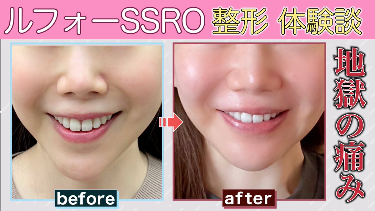 87seikei's tweet photo. 今日投稿した動画はルフォー、SSRO、両顎骨切り手術のインタビュー動画です！

施術内容やダウンタイム、施術したクリニックなど実体験を語ってもらいました🙇‍♂️

ルフォーや両顎骨切りを考えている人は見て絶対に損させません!!👀🌱
https://t.co/oHPFlbkDsh https://t.co/qxs59tPIzV