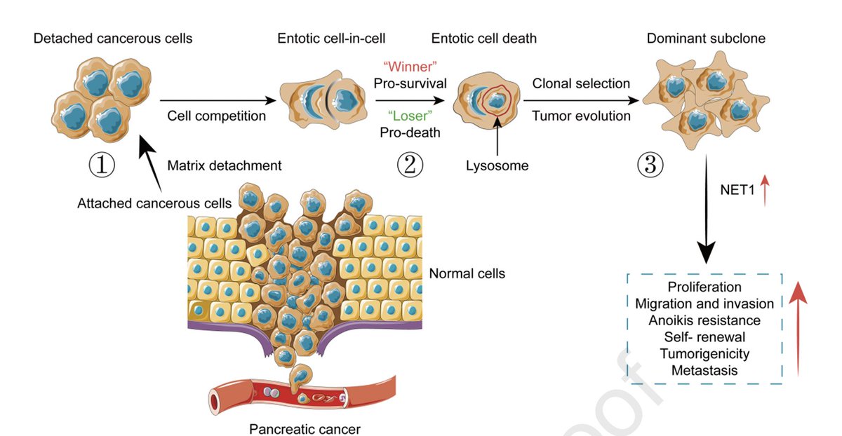 In @AGA_Gastro: 
Cell-in-Cell-Mediated Entosis Reveals A Progressive Mechanism in #PancreaticCancer
gastrojournal.org/article/S0016-…
Entosis is a cell-in-cell phenomenon that is associated with poor prognosis in pancreatic cancer. This study identified NET1, neuroepithelial cell…