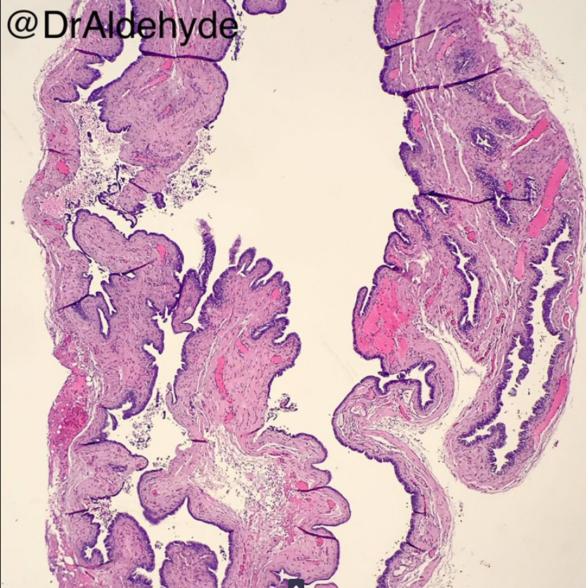 Posterior mediastinum of a woman. Diagnosis? More pics (with immunostains) & Answer: kikoxp.com/posts/8873 More posts from Dr. Cho @DrAldehyde kikoxp.com/woo_cheal_cho3 #pathology #pathTwitter #medTwitter