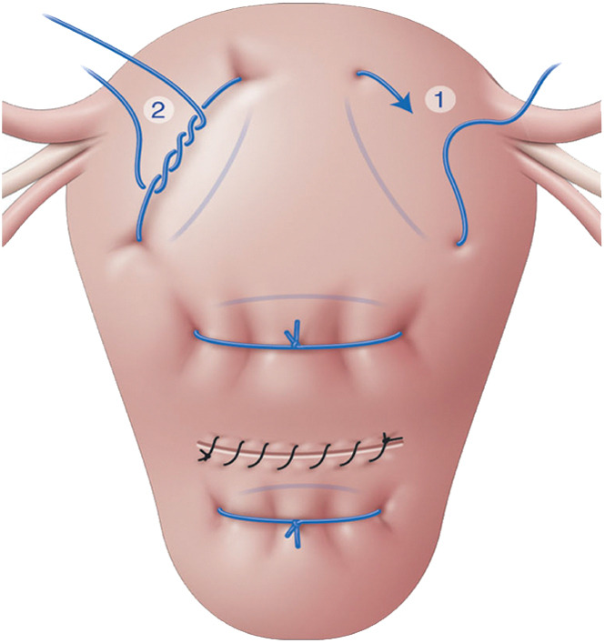 AJOG_thegray's tweet photo. AJOG Expert Review in Labor:  Uterine-sparing surgical procedures to control postpartum hemorrhage - Ouahba’s uterine compression sutures https://t.co/5UEbnEWbeI https://t.co/VEzjq6kcpk