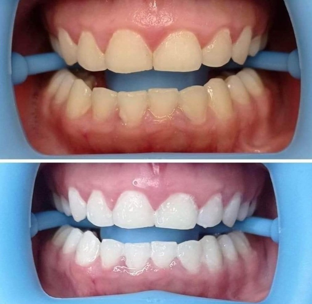 BLANCHIMENT DENTAIRES OFFRE ANNIVERSAIRE JUSQU'AU 15/9/2023
60€ AU LIEU DE 90€
gagné 2 à 6 teintes en 2 séance de 25 m <a href="/Bodyfish/">빈나</a> 37 grand rue 68180 Horbourg Wihr 0672754441

bodyfish.fr/nos-soins-rela…

Achetez ici CARTE CADEAU VALABLE 6 MOIS  bodyfish.fr/carte-cadeau-p…