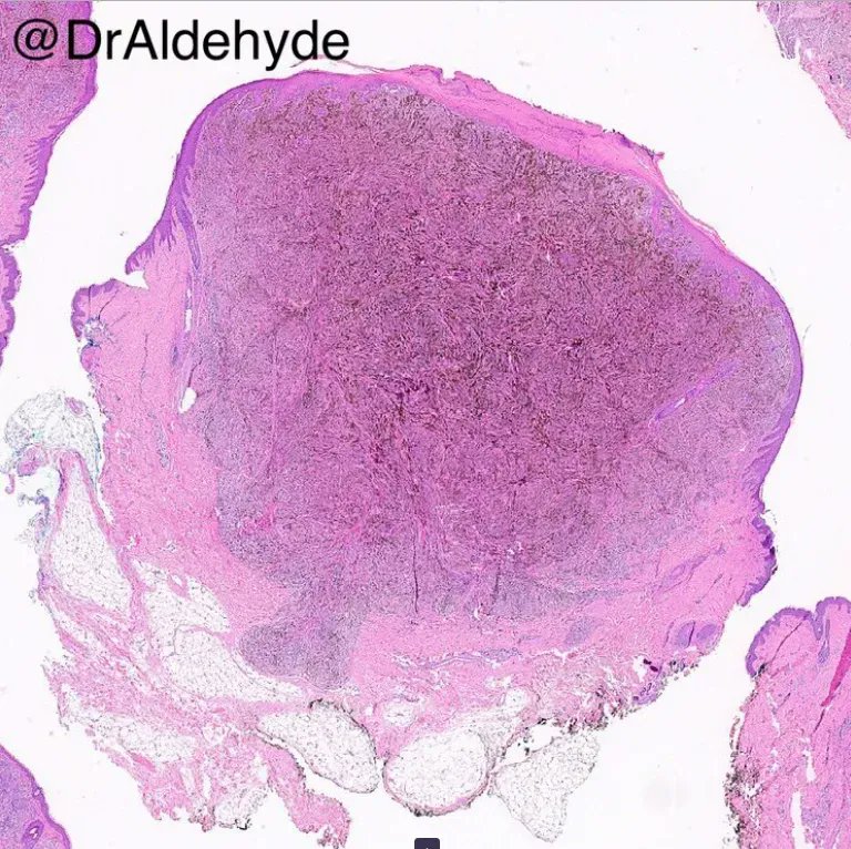 For morphology lovers. Diagnosis? More pics & Answer: kikoxp.com/posts/9554 More posts from Dr. Cho @DrAldehyde kikoxp.com/woo_cheal_cho3 #medTwitter #pathology #pathologists #pathTwitter #dermpath #dermatology #dermatologia #dermtwitter