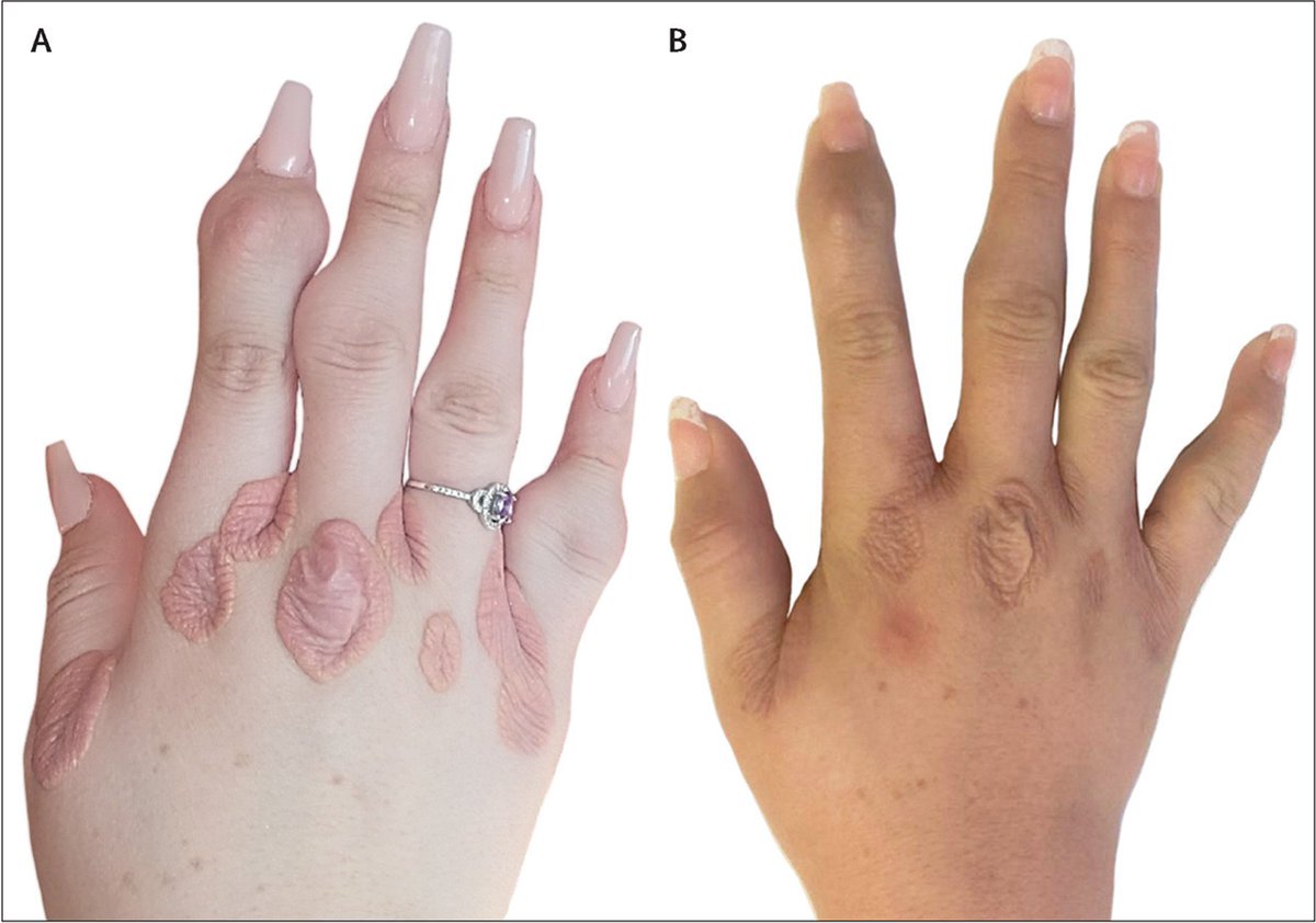 “Regression of cutaneous xanthomata in patient with homozygous familial hypercholesterolemia using novel therapies”: a new Clinical Picture. hubs.li/Q020-XD30