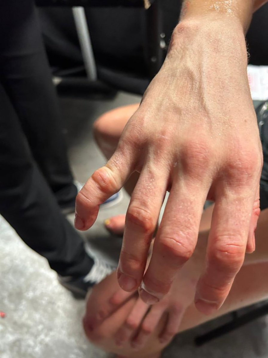 UFCxFightNight's tweet photo. Rose Namajunas revealed her broken finger from UFC Paris https://t.co/9CVYLQNURS