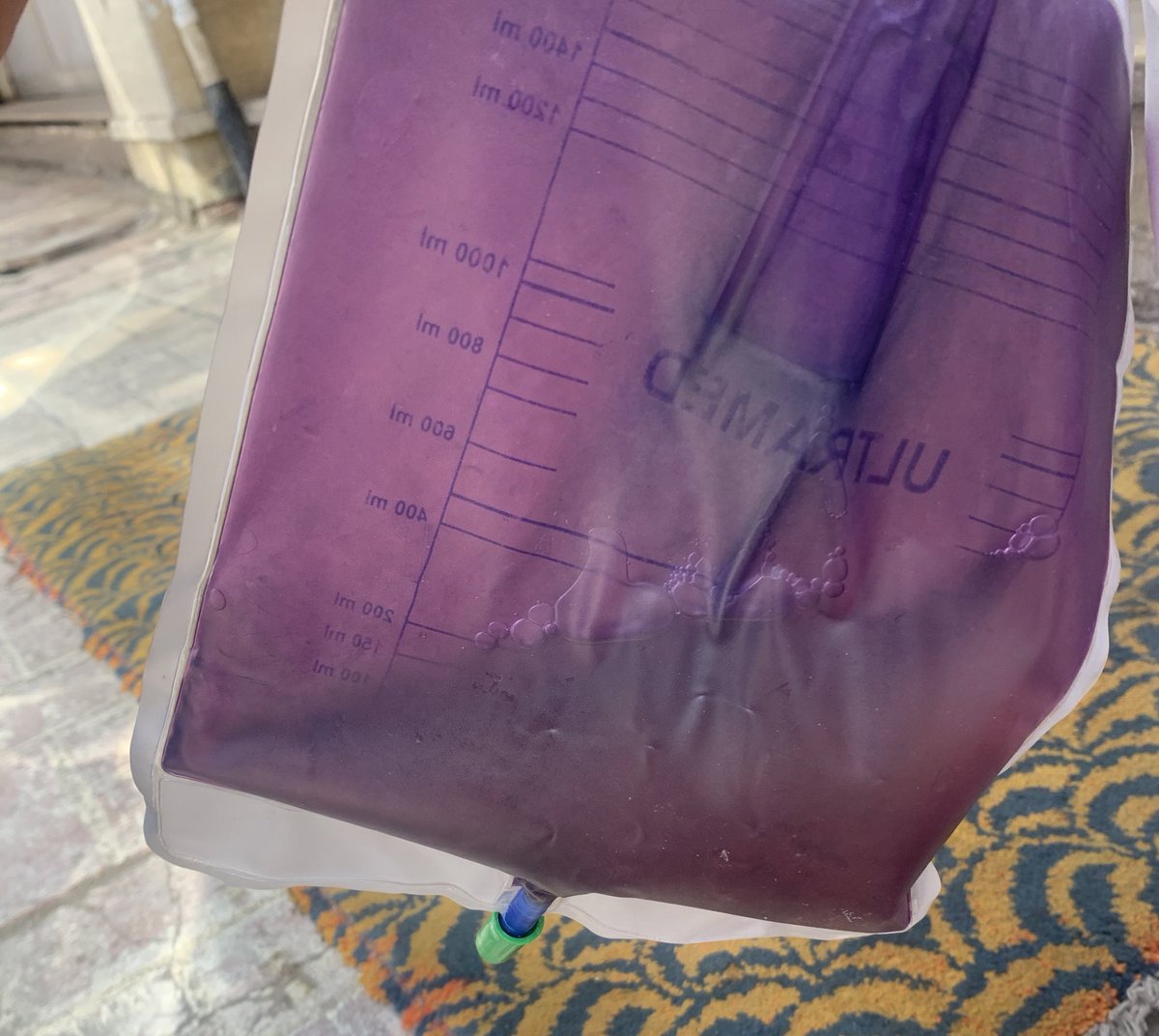 Have you seen the Purple Urine Bag Syndrome (PUBS) before?!
1st time to actually see it.