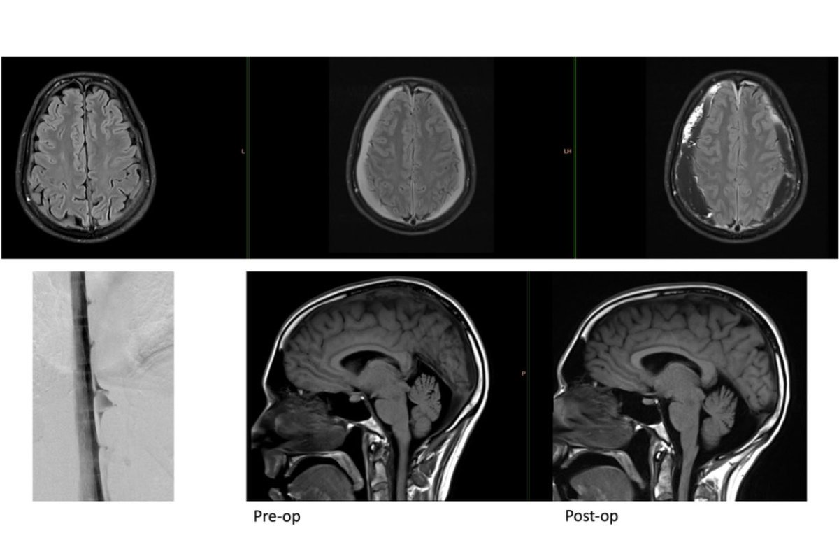 WouterSchievink's tweet image. Progression of spontaneous subdural hematomas in a young man over a 3 month period with an untreated lateral #spinalCSFleak. Various barriers to receiving care. He requested surgical repair so he could travel overseas without worrying about the hematomas. ⁦@spinalCSFleak⁩