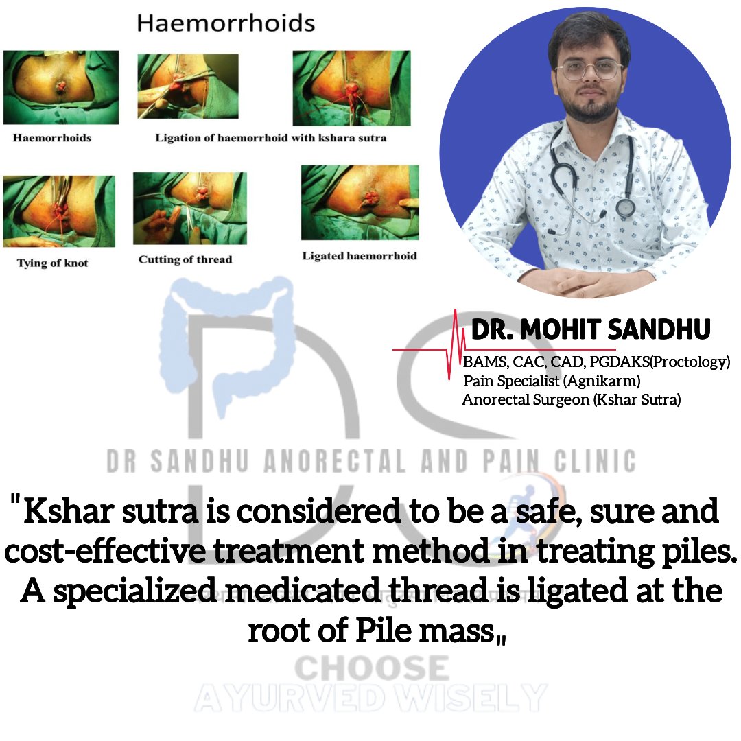 Kshar sutra is considered to be a safe, sure and cost-effective treatment method in treating piles. A specialized medicated thread is ligated at the root of Pile mass. 

#ayurved #ksharsutra