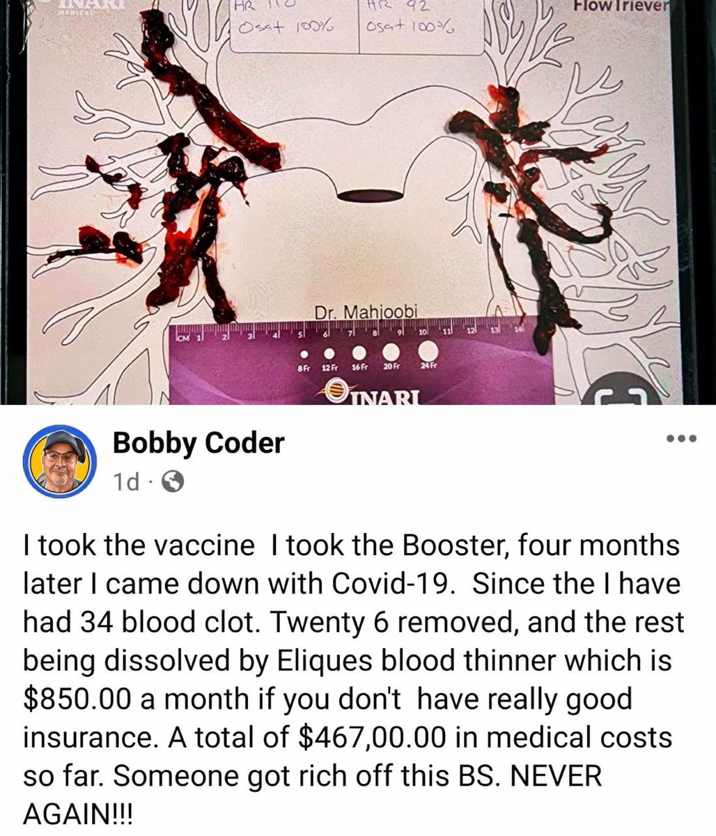 Vaccinated &amp; boosted. 

34 blood clots.