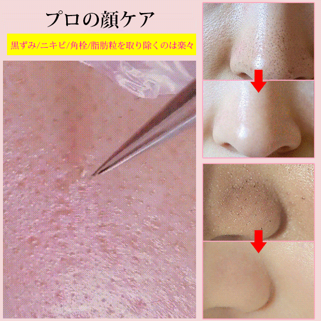 goaszy's tweet photo. 美容師のおすすめ👍ドイツ工芸、0.5ｍｍの精度、黒ずみ/ニキビ/角栓/脂肪粒を取り除くのは楽々✨
https://t.co/G003TjcVfr https://t.co/sg99cKI3hg