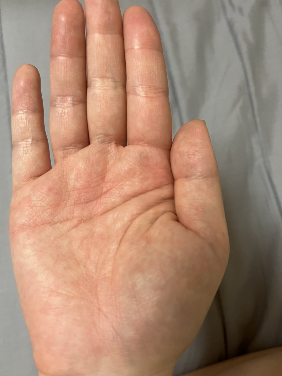 ゾコーバ効くけど左手が赤くなってとても痒い〜😭手以外も至る所が痒いよ😭それでも飲まなきゃもっと辛いから飲むけどね