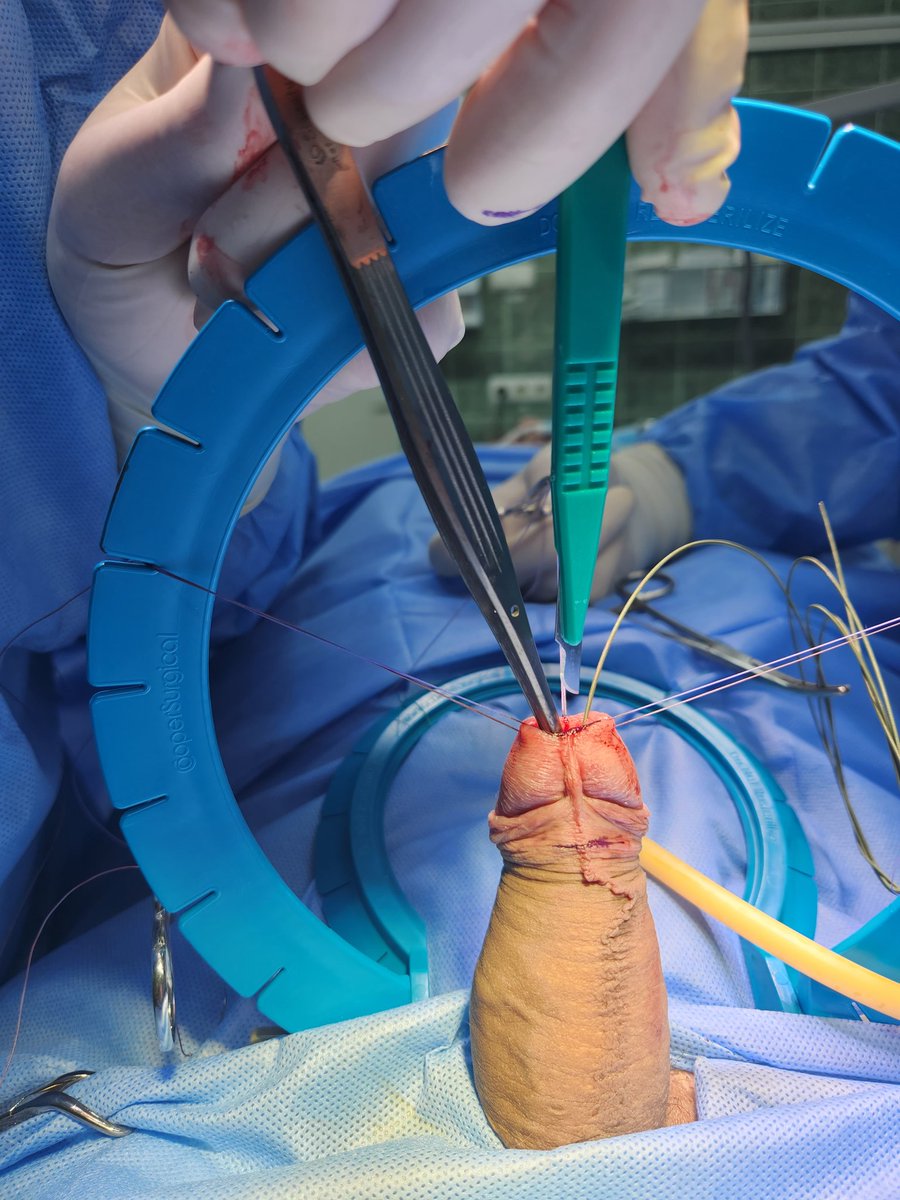 kobirni4enko's tweet photo. Transurethral ventral BMG urethroplasty for fossa navicularis urethral stricture. Our reconstruction team in action
@UroRecon @v_bond1990 @bidula_y  @Polion_Mykyta @SocietyGURS 
#urology
#Urethroplasty 
#Kyiv #Ukraine https://t.co/X9yVOuSSrk