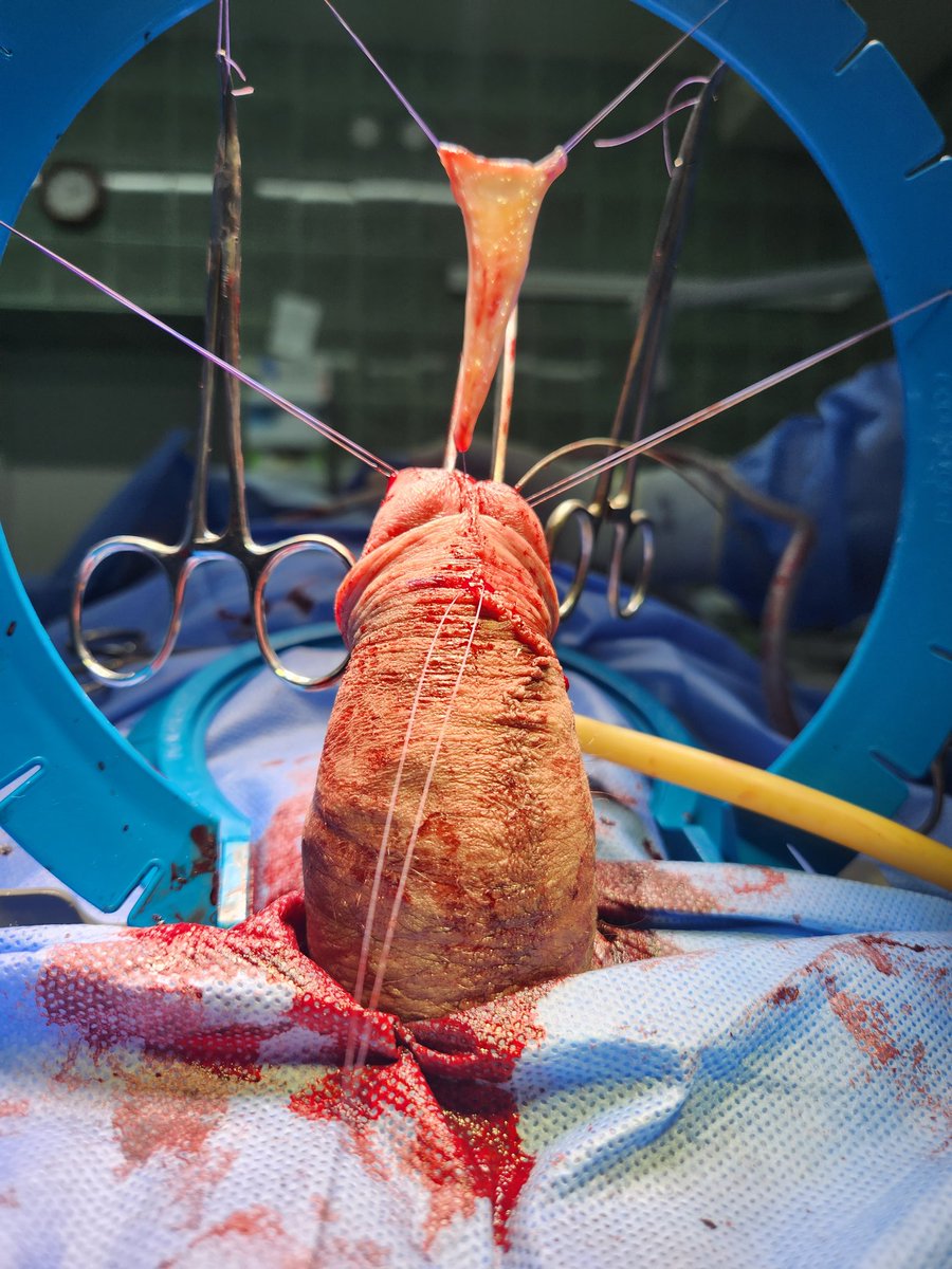 kobirni4enko's tweet photo. Transurethral ventral BMG urethroplasty for fossa navicularis urethral stricture. Our reconstruction team in action
@UroRecon @v_bond1990 @bidula_y  @Polion_Mykyta @SocietyGURS 
#urology
#Urethroplasty 
#Kyiv #Ukraine https://t.co/X9yVOuSSrk