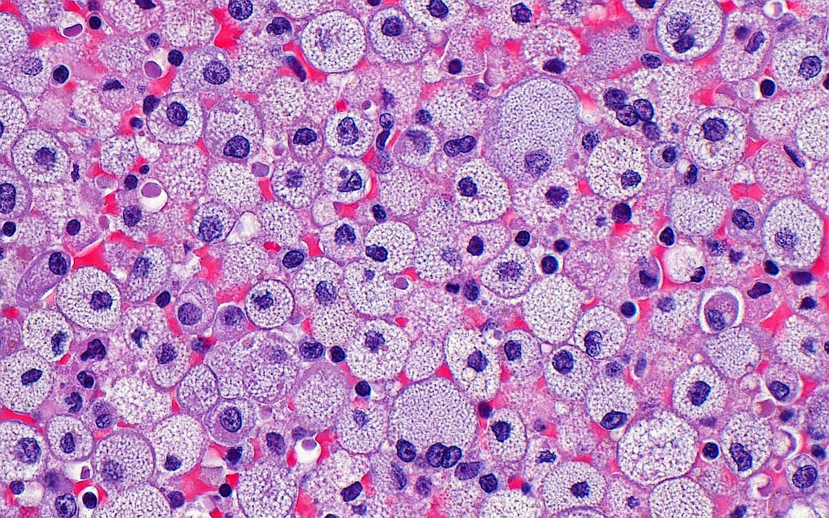 Foamy Histiocytes ~ 🧼 #PathArt