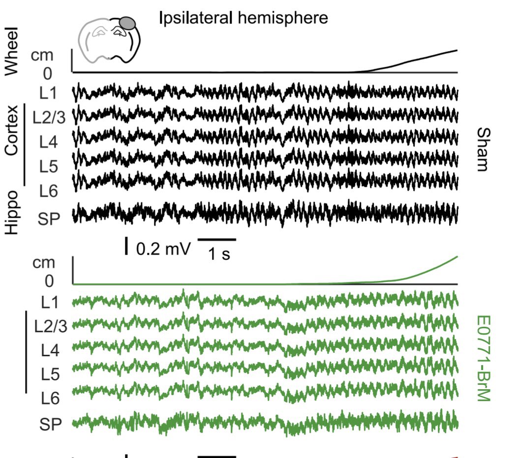 Liset M de la Prida (@lmprida) on Twitter photo New 📝 in <a href="/Cancer_Cell/">Cancer Cell</a>! Together with <a href="/valientelab/">Manuel Valiente</a> we look at the electrophysiological signatures of 🧠 metastasis, using multi-electrode recordings and #MachineLearning . By Alberto Sanchez-Aguilera, <a href="/mariam_masmudi/">Mariam Al-Masmudi Martín</a> <a href="/acnavasolive/">Andrea Navas-Olive</a> & many others👉🏼 📝 sciencedirect.com/science/articl… 👇🏼🧵 New 📝 in <a href="/Cancer_Cell/">Cancer Cell</a>! Together with <a href="/valientelab/">Manuel Valiente</a> we look at the electrophysiological signatures of 🧠 metastasis, using multi-electrode recordings and #MachineLearning . By Alberto Sanchez-Aguilera, <a href="/mariam_masmudi/">Mariam Al-Masmudi Martín</a> <a href="/acnavasolive/">Andrea Navas-Olive</a> & many others👉🏼 📝 sciencedirect.com/science/articl… 👇🏼🧵