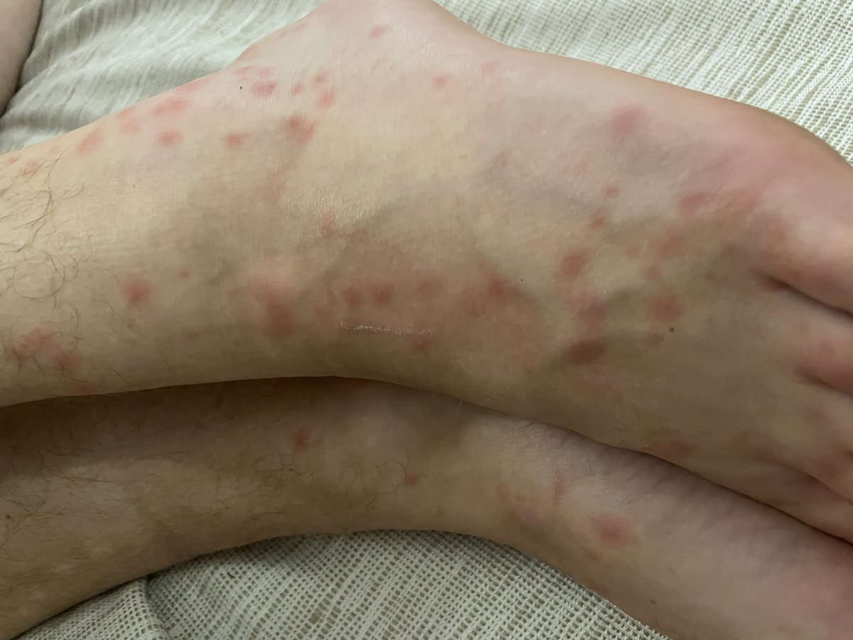 kirstyylou154's tweet photo. Spend £9600 on an all inclusive holiday to Tenerife that you work hard all year round for to go away and be bitten head to toe by bed bugs, 4 out of 9 get food poisoning from the food, absolutely vile. Don’t go away with this company the customer service is shocking @TUIUK https://t.co/GLiF10BbgL