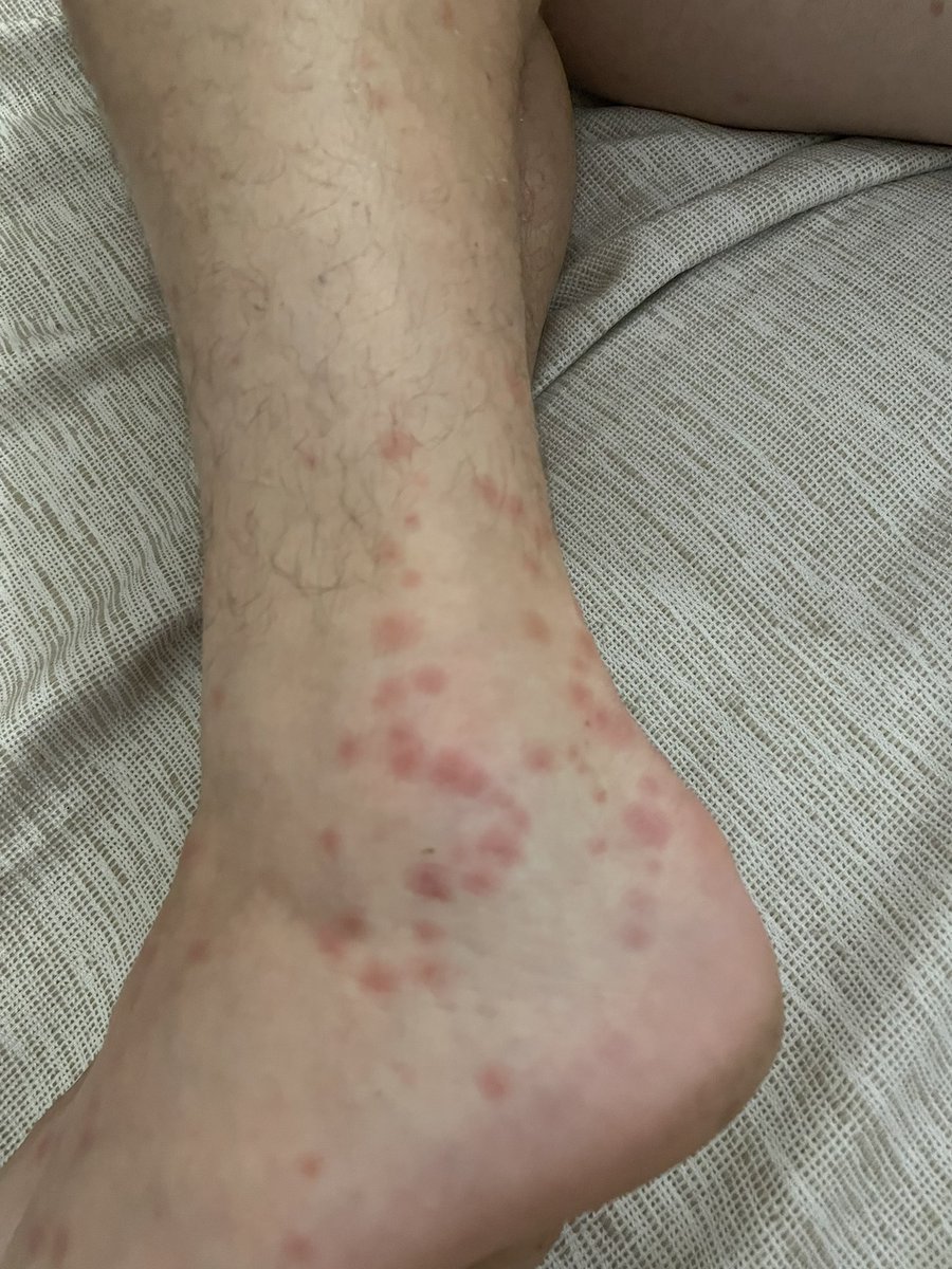 kirstyylou154's tweet photo. Spend £9600 on an all inclusive holiday to Tenerife that you work hard all year round for to go away and be bitten head to toe by bed bugs, 4 out of 9 get food poisoning from the food, absolutely vile. Don’t go away with this company the customer service is shocking @TUIUK https://t.co/GLiF10BbgL