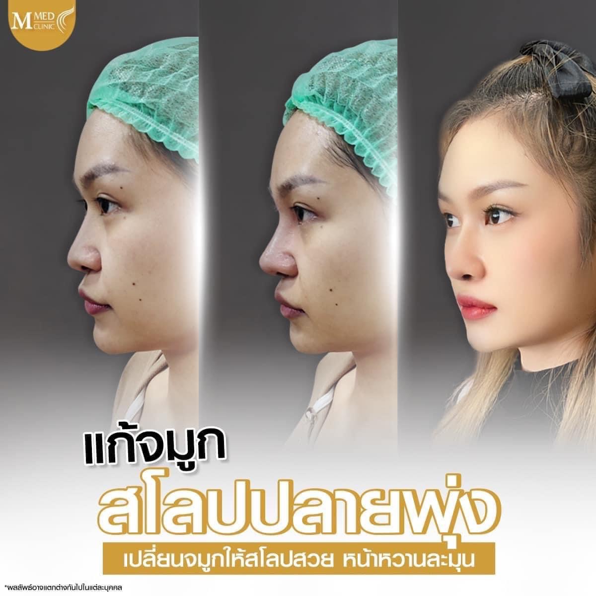 ClinicMmed's tweet photo. รีวิวเสริมจมูก จากลูกค้าคนน่ารักของเรา ละมุนสุบๆ
#mmedclinic #เอ็มเมดคลินิค #รีวิวเอ็มเมด #ฉีดผิว #โปรดีบอกต่อ #Botox #filler #ฟิลเลอร์ #ฉีดผิว #เลเซอร์รักแร้ https://t.co/PlRpXW7o5k