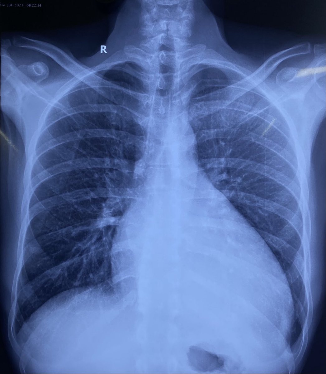 For residents/ fellows. Why this 55 yr old male is complaining of palpitation