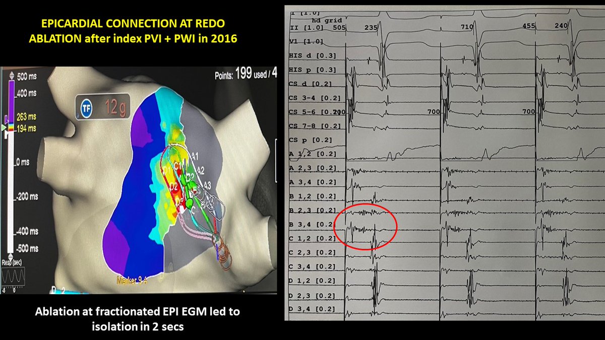 peterkistler3's tweet photo. Great example of long fractionated EGM from EPICARDIUM inside the box on High density catheter which could not be seen on ablator @DrRoderickTung https://t.co/QOmQHhuiS8