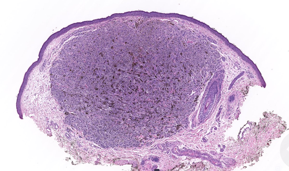 KiKo (@kiko4docs) on Twitter photo What would you call this lesion?
WSI digital slide, Dermoscopy, & Answer (in comments): kikoxp.com/posts/5094
More posts from Dr. <a href="/VKazlouskaya/">Viktoryia Kazlouskaya, MD/PhD</a> kikoxp.com/viktoryia_kazl…
#medTwitter #pathology #pathologists #pathTwitter #dermpath #dermatology #dermatologia #dermtwitter What would you call this lesion?
WSI digital slide, Dermoscopy, & Answer (in comments): kikoxp.com/posts/5094
More posts from Dr. <a href="/VKazlouskaya/">Viktoryia Kazlouskaya, MD/PhD</a> kikoxp.com/viktoryia_kazl…
#medTwitter #pathology #pathologists #pathTwitter #dermpath #dermatology #dermatologia #dermtwitter