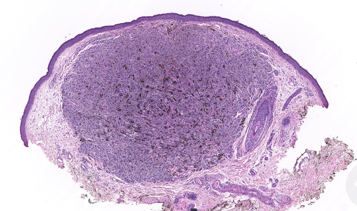 What would you call this lesion? WSI digital slide, Dermoscopy, & Answer (in comments): kikoxp.com/posts/5094 More posts from Dr. @VKazlouskaya kikoxp.com/viktoryia_kazl… #medTwitter #pathology #pathologists #pathTwitter #dermpath #dermatology #dermatologia #dermtwitter