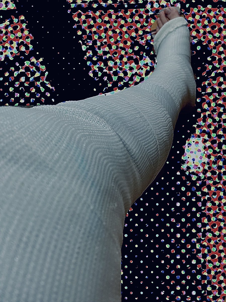 JfG4l's tweet photo. #骨折　#ギプス　#石膏　#legcast #castfetish https://t.co/SDEMZtThtZ