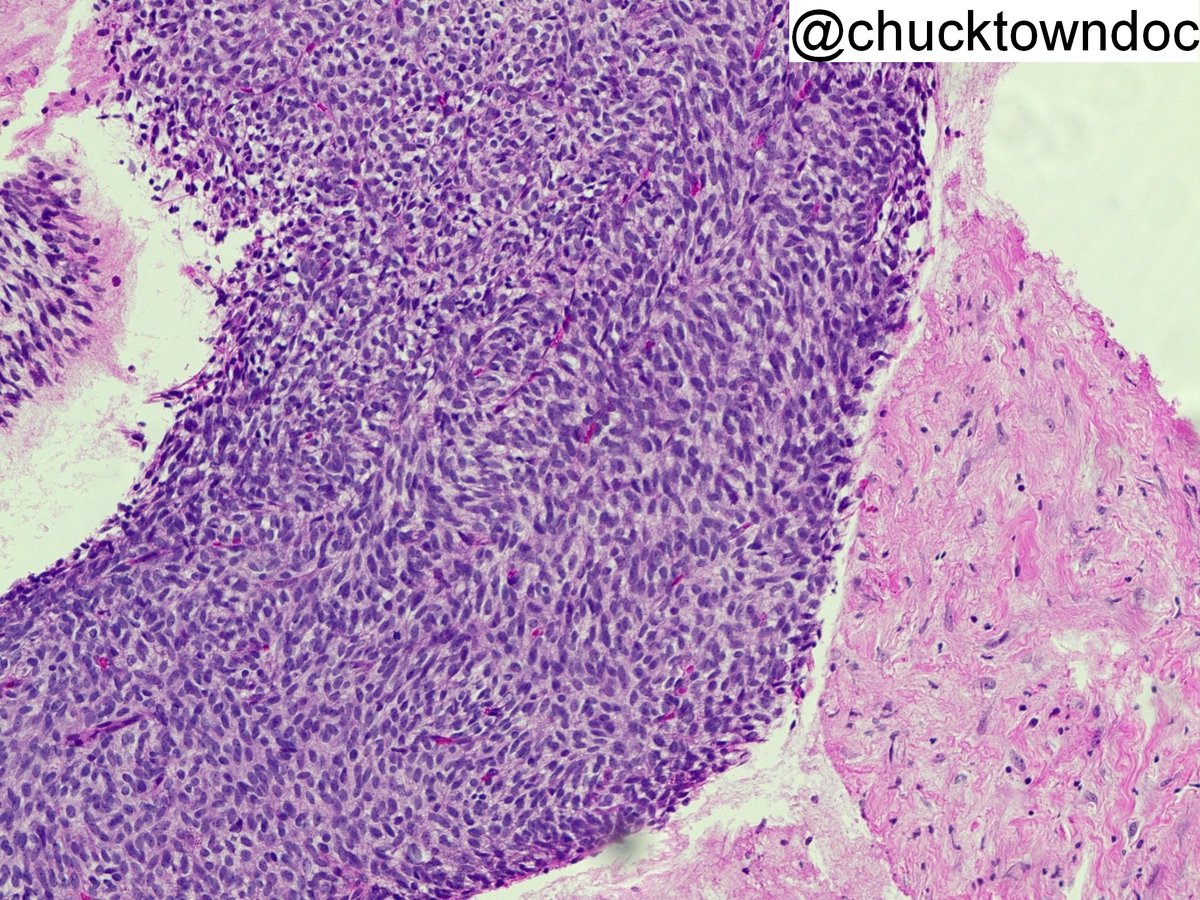 kiko4docs's tweet image. Pancreatic mass in young adult male. EUS FNA. 
What is the diagnosis? What single stain could confirm it? 
Answers: kikoxp.com/posts/16463 
More posts from Dr. Ingram @Chucktowndoc kikoxp.com/frank_ingram3
#pathology #pathTwitter #medTwitter