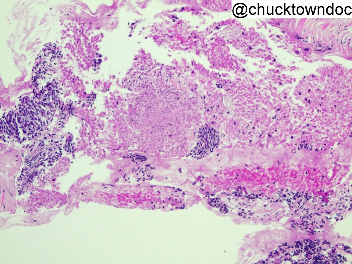 Pancreatic mass in young adult male. EUS FNA. What is the diagnosis? What single stain could confirm it? Answers: kikoxp.com/posts/16463 More posts from Dr. Ingram @Chucktowndoc kikoxp.com/frank_ingram3 #pathology #pathTwitter #medTwitter