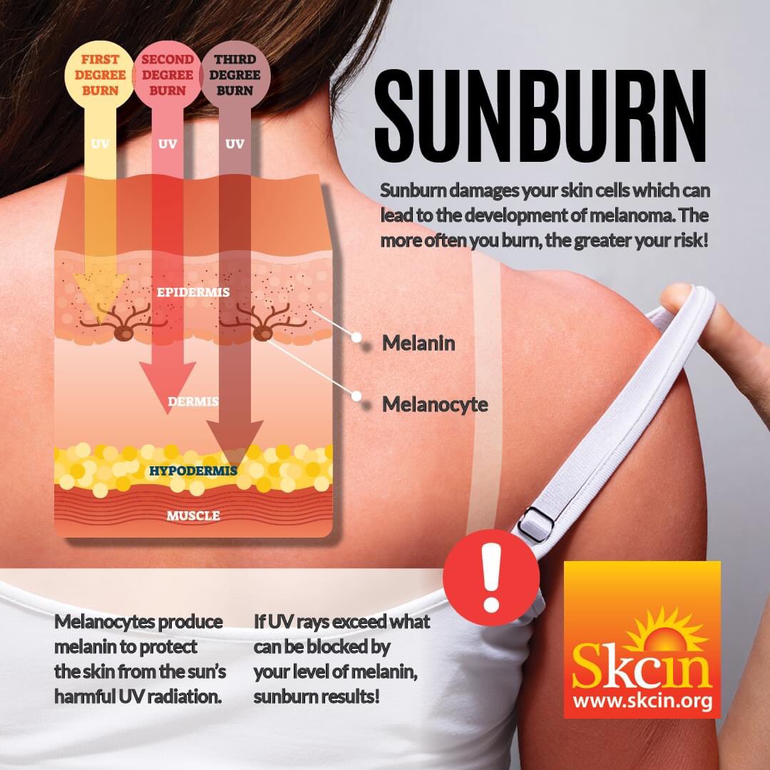 SkcinCharity's tweet photo. With temperatures soaring over the next week across the UK - take care to protect your skin!

SUNBURN, REDDENING, PEELING AND EVEN TANNING OF THE SKIN IS CLEAR INDICATION OF SUN DAMAGE. OVER-EXPOSURE TO UVA AND UVB CAUSES DNA CELL DAMAGE THAT CAN LEAD TO ALL TYPES OF SKIN CANCER. https://t.co/Lh7PdzjGTm