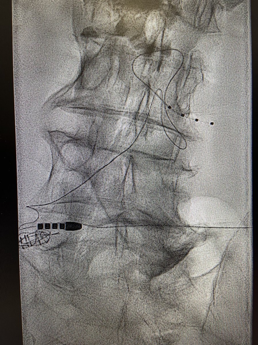 herrero_dr's tweet photo. Primer electrodo DRG implantado en @HMHOSPITALES 🙌🏻👏👏👏👏 Paciente con gonalgia y dolor mantenido por simpático. #neuromodulation #drgstimulation #interventionalpainmanagement #paininstituteofspain #iptprogram #pios . Gracias @AbbottGlobal por todo el apoyo https://t.co/ogEghVdct0