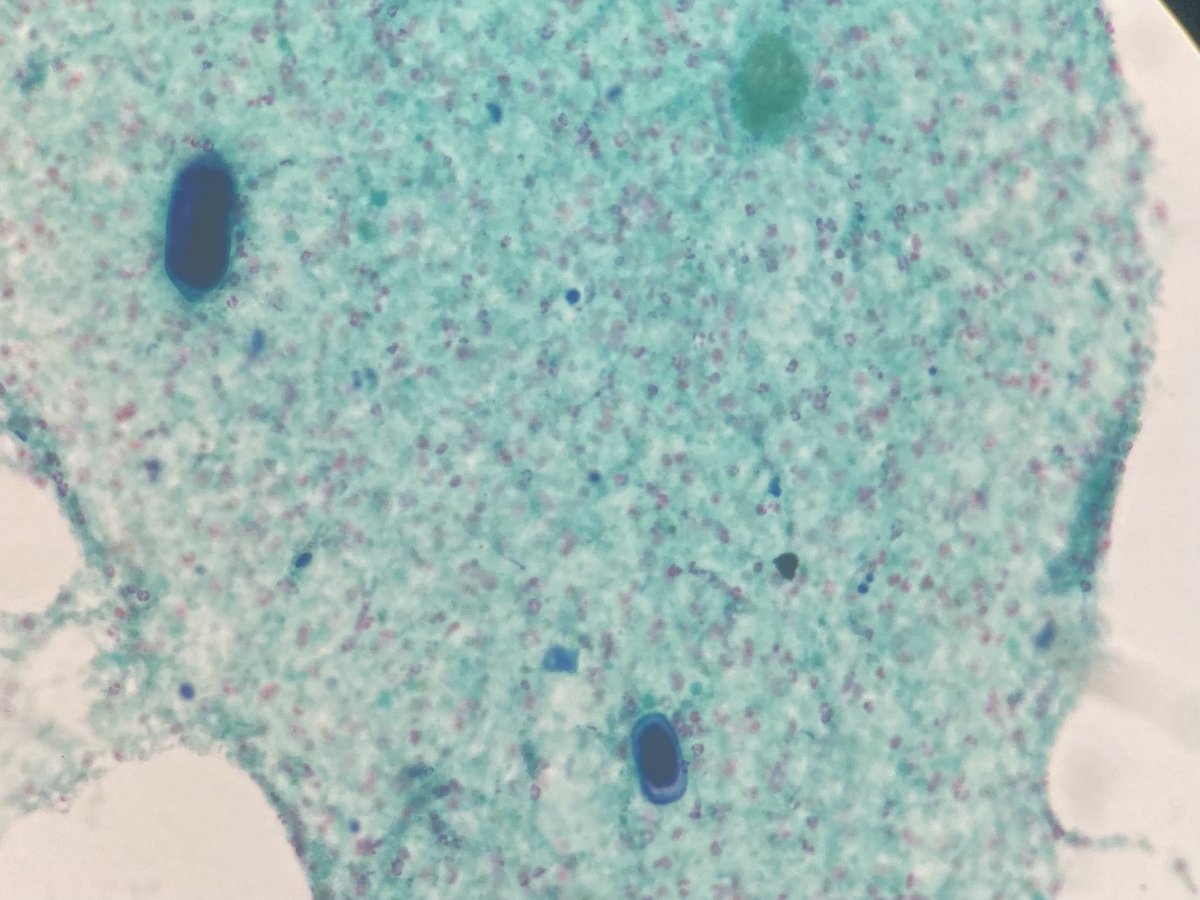 ksaipatt's tweet photo. Start the day with M28 FNA from 2 cm lung nodule 👀 No underlying disease, not sure about Ascaris. Any idea please? #PathTwitter https://t.co/7khCCIiOAk