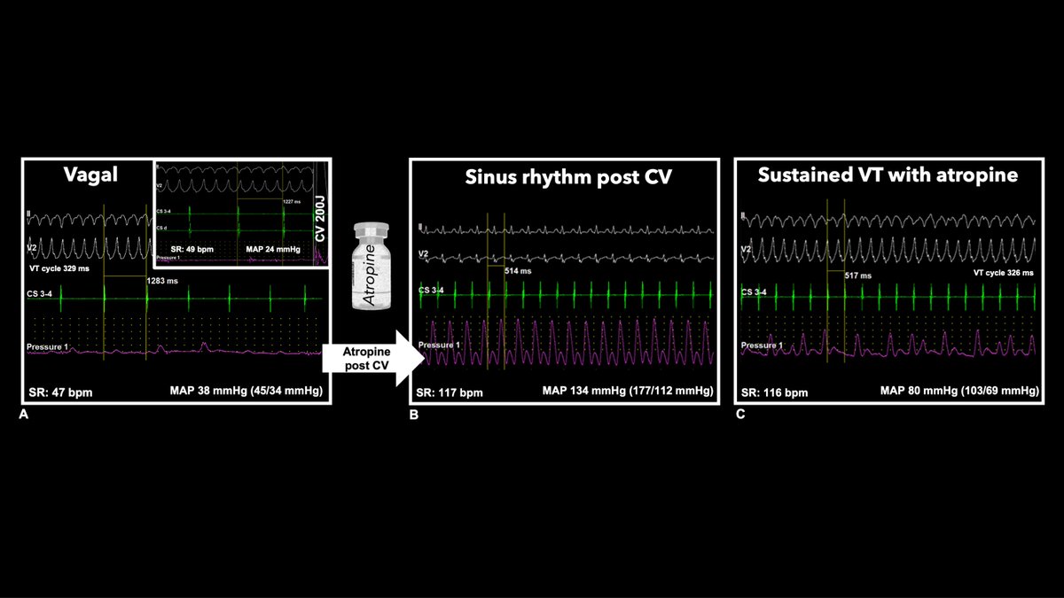 Love new insights into human physiology! Our first paper in @JACCJournals is a huge 2nd milestone @uazmedphx.🔥🌵 We closely analyzed sinus rates during VT and found a surprising proportion with inappropriate bradycardia, during a life-threatening episode. Do humans have a…