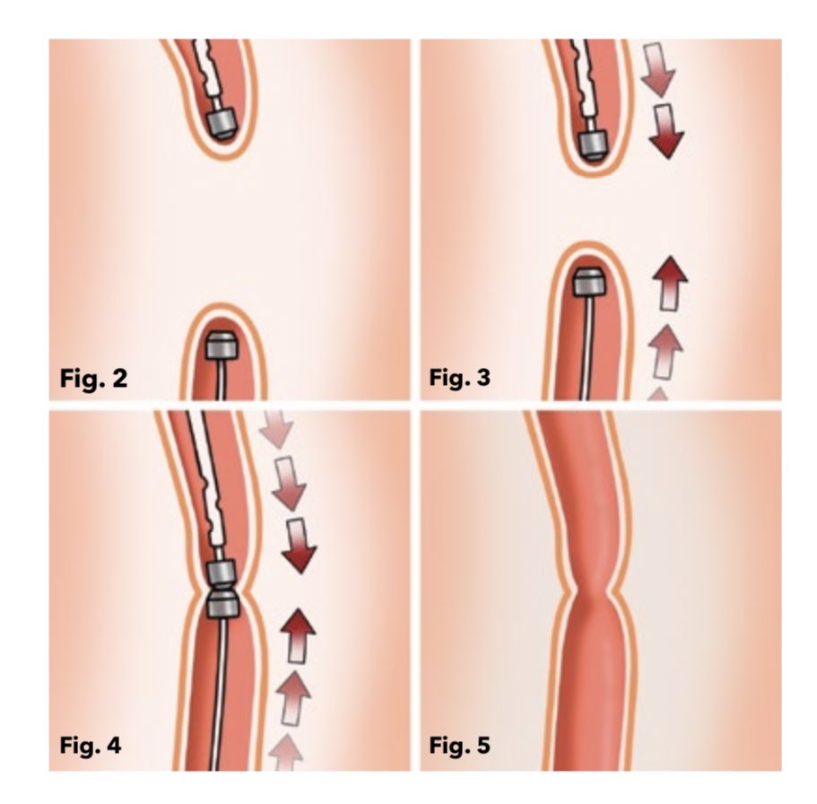 Dispositivo FLOURISH 🧲
El uso de imanes como alternativa no quirúrgica para la anastomosis de atresia esofágica 
El dispositivo consta de un catéter esofágico y un gástrico cada uno con un imán de neodimio

#SoMe4Surgery